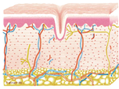 Rimodellazione del Collagene Radiofrequenza